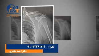 شکستگی استخوان شانه