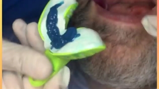 مراحل قالبگیری از ریشه باقیمانده جهت ساخت پست فلزی