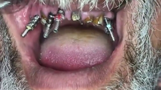 مراحل قالبگیری ایمپلنت های فک بالا