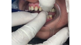 مرحله امتحان تطابق لامینیت های سرامیکی داخل دهان بیمار