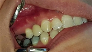 مراحل تحویل یک واحد روکش تمام سرامیک زیرکونیا روی ایمپلنت