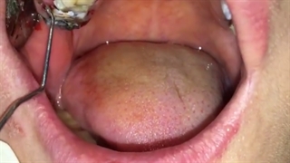 مشکل روکش های رایج قسمت سوم