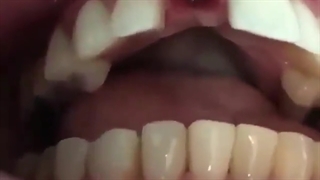 تحویل پروتز موقتی