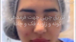 فیلم تزریق چربی به گونه روکش دندان