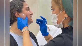 فیلم زاویه سازی صورت با تزریق بوتاکس