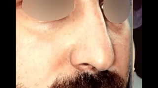 بلافاصله بعد از جراحی بینی گوشتی | دکتر غلامرضا بیاضیان پیلینگ شیمیایی