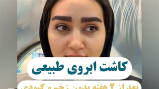 کاشت ابرو بعد از دو هفته
