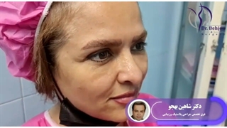 لیفت شقیقه،ابرو و پیشانی به روش اندوسکوپی