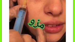 هزینه، فواید و تعداد جلسات مزوتراپی صورت