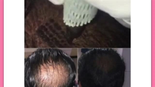 افزایش تراکم یا پرپشت شدن موی سر با روش های مدرن و خانگی
