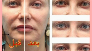 آیا هایفو واقعا تاثیر دارد؟ نتایج بعد از هایفوتراپی