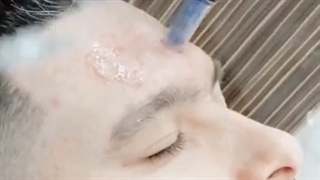 مزونیدلینگ صورت