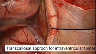 عمل جراحی تومور داخل بطنی