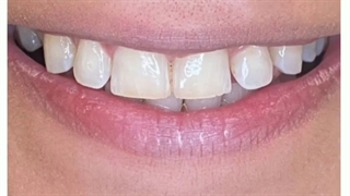 ونیز کامپوزیت