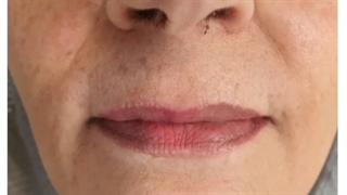 تزریق فیلر برای بهبودی خطوط دور دهان چین خنده و خط غم و خطوط ریز بالای لب