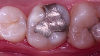 تعویض آمالگام با کامپوزیت