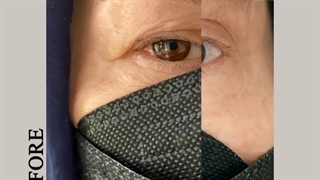 قبل و بعد عمل جراحی زیبایی پلک