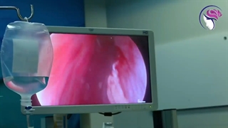 ارتباط بین سینوزیت و پولیپ بینی با آسم