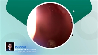 جراحی بالون توبولوپلاستی شیپور استاش چیست