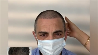 نمونه کاشت مو