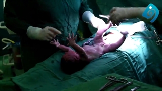 فیلم واقعی سزارین و خارج کردن فیبروم