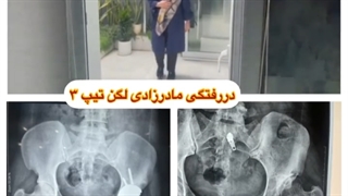 دررفتگی مادرزادی لگن