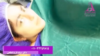 جانان عزیزم که بخاطر وضعیت بریچ با روش سزارین متولد شد