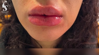 فیلم تزریق ژل لب