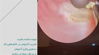 آیا درباره تخریب آندومتریوز چیزی میدونید ؟