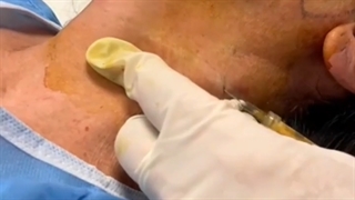 تزریق سلولهای بنیادی بافت چربی