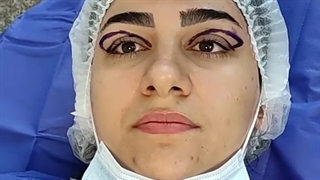 بلفاروپلاستی و جراحی پلک توسط فوق تخصص پلاستیک -کلینیک vip تهران