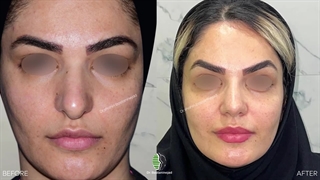 جراحی بینی گوشتی با قوز و افتادگی نوک بینی | دکتر باستانی نژاد