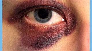 علل و نحوه درمان ورم و کبودی چشم بعد از کاشت ابرو