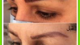 قدم به قدم با کاشت موی طبیعی | نتیجه نهایی کاشت مو چه زمانی است؟