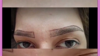 معایب،مزایا و هزینه ترمیم مو به روش HRT