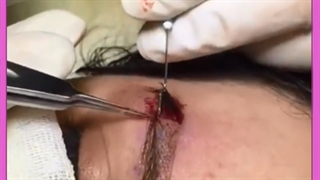 عوامل موثر در ماندگاری کاشت ابرو را بشناسید