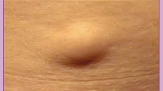 لیپوم یا غده چربی زیر پوست چیست؟