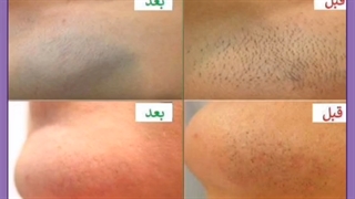 زمان دقیق ریزش موها بعد از لیزر