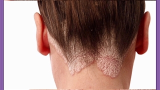 همه آنچه باید درباره پسوریازیس و درمان آن بدانید