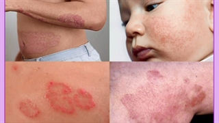 آشنایی با انواع اگزمای پوست و راهکارهای درمانی آن