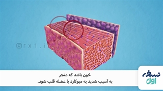 نکاتی راجب سکته قلبی - داروخانه اینترنتی نسخه اول - داروخانه آنلاین سخه اول