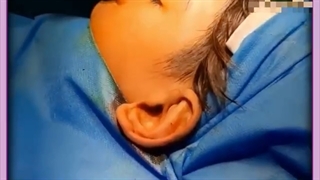 اتوپلاستی چیست و چگونه انجام می شود؟