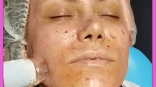 آر اف کونتراج