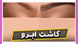 بهترین سن کاشت ابرو طبق نظر پزشکان متخصص