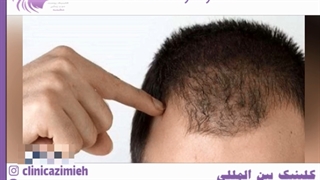 ۱۰ دلیل اصلی ریزش مو در جوانان و راهکارهایی برای درمان سریع