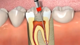 صفر تا صد عصب کشی دندان در یک ویدیو کوتاه