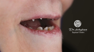 ایمپلنت و تحویل روکش