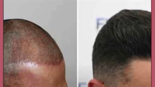 بهترین مرکز کلینیک پزشکی کاشت مو در آمل کجاست؟
