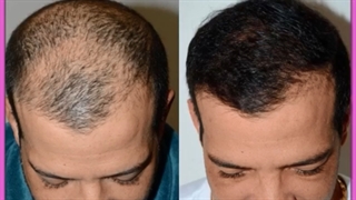 قدم به قدم با کاشت موی طبیعی | نتیجه نهایی کاشت مو چه زمانی است؟