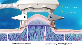 چگونه کرایولیپولیز باعث لاغری موضعی می شود؟